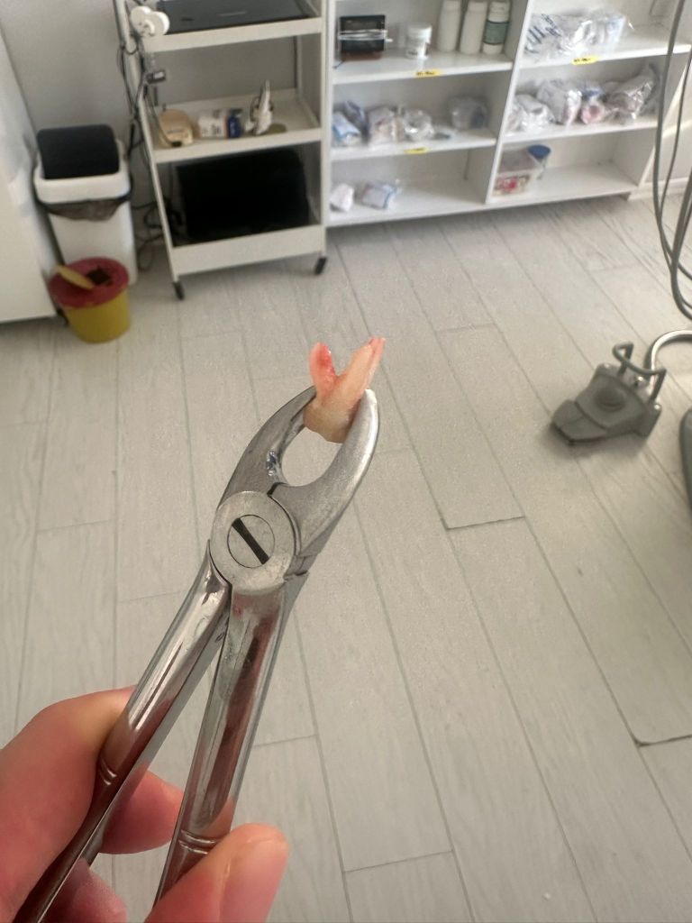 Çayırova dişçi odasında diş çekimi işlemi yapmış bir Çayırova diş hekimi elinde çekilmiş bir diş tutuyor.
