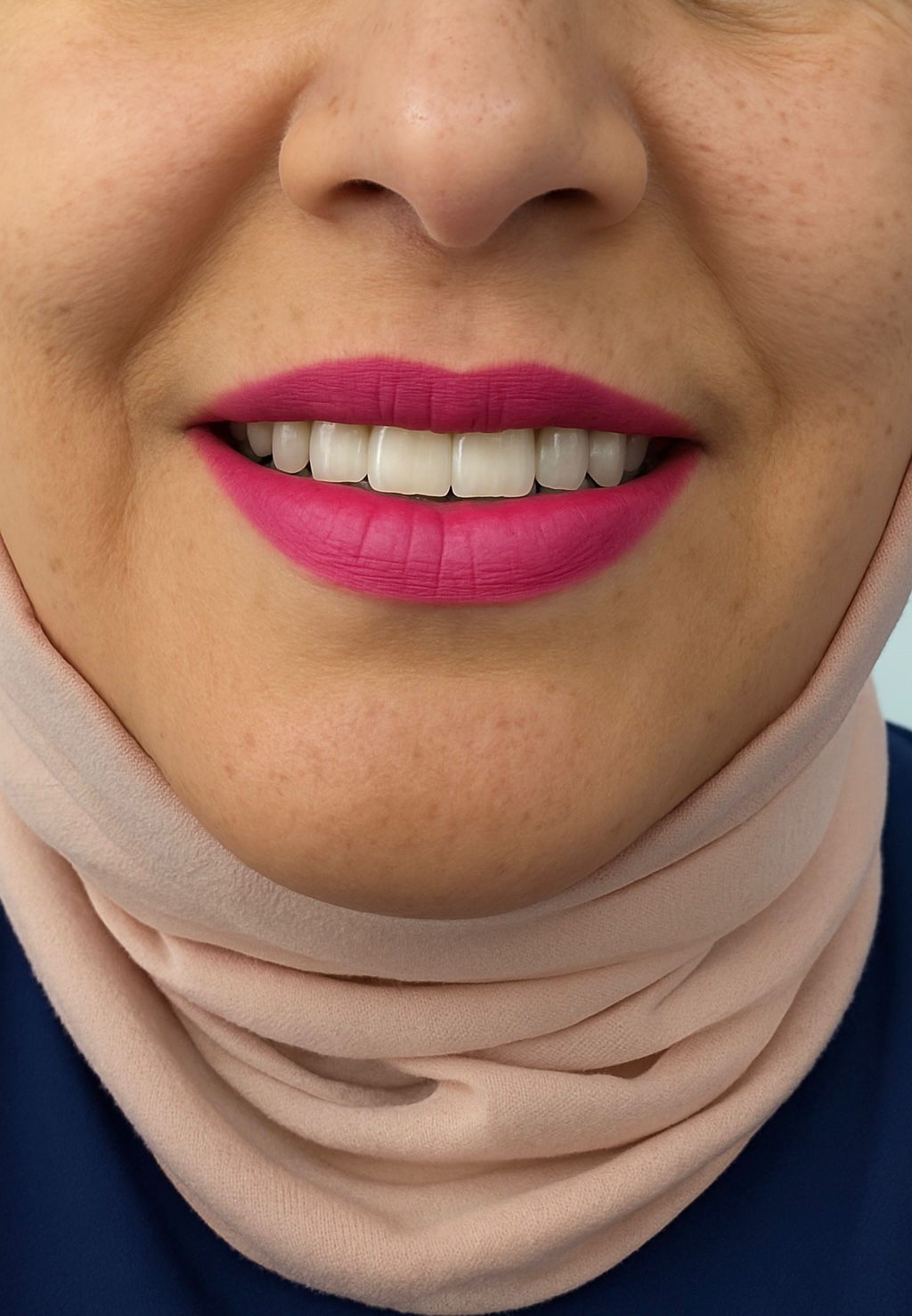 2025 Porselen Diş Kaplama Fiyatları ve Fiyatları Etkileyen Faktörler